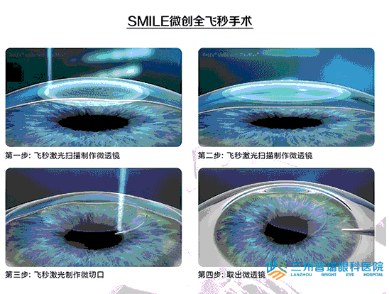 蘭州全飛秒激光近視手術(shù)無(wú)瓣(smile)技術(shù)