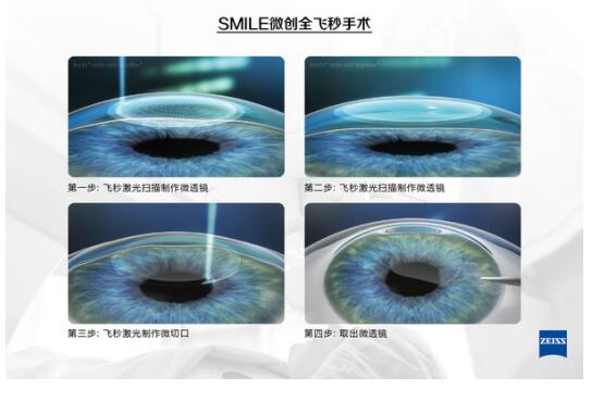 有近視，全飛秒激光手術(shù)后視力更好