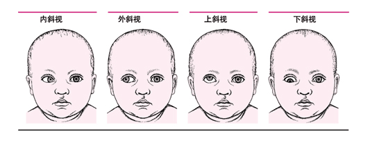 孩子有斜視做手術矯正有什么危險？