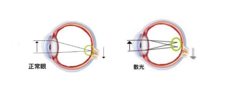 高度散光加近視可以做手術(shù)嗎？